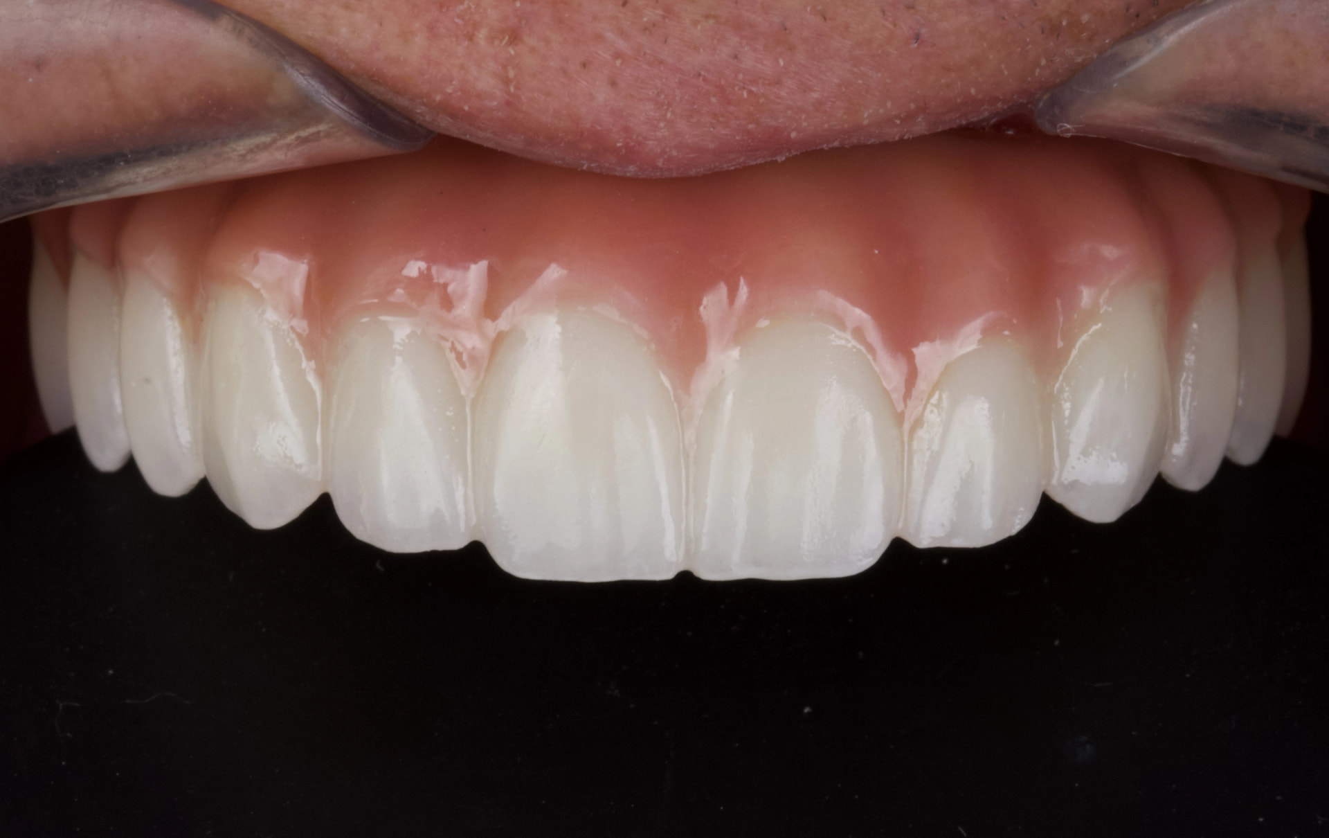 Sorriso finalizado com prótese fixa em zircônia, vista frontal dos dentes superiores